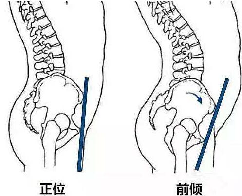 盆骨前倾侧面骨图图片